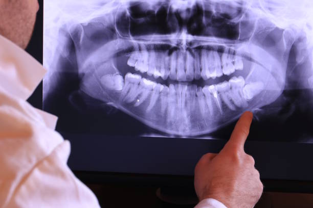 Best Emergency Tooth Extraction in Fort Polk North, LA