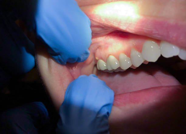 Best Emergency Root Canal Treatment in Fort Polk North, LA