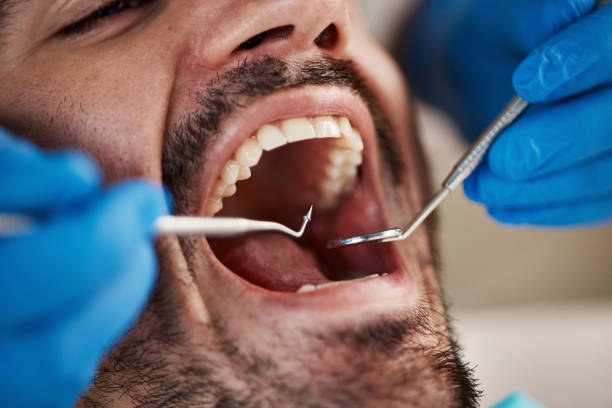 Best Emergency Treatment for Dental Infections or Abscesses in Fort Polk North, LA