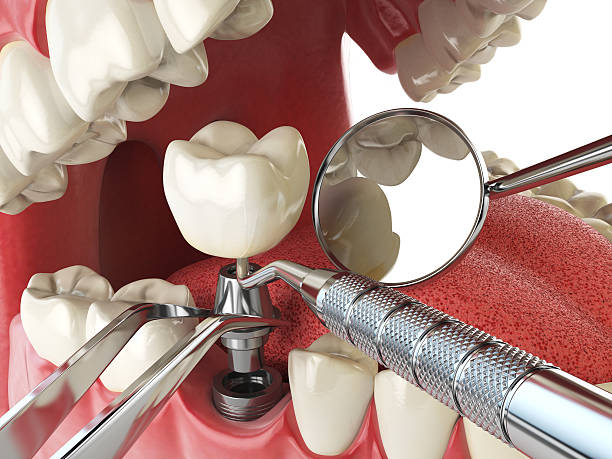 Best Emergency Tooth Extraction in Fort Polk North, LA